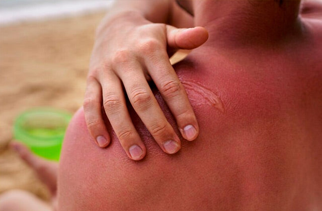 ☀️ ¿Sabías que el sol puede dejar huellas irreversibles en tu piel?