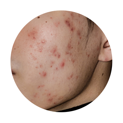 Consulta dermatologica para el acne