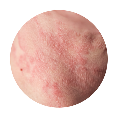 Consulta dermatologica para la dermatitis