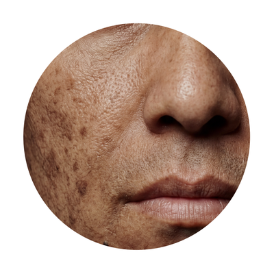 Consulta dermatologica para melasma y manchas