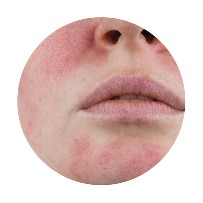 Consulta dermatologica de rosacea